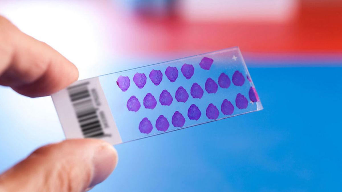 Un nuevo análisis de sangre permitirá detectar rápidamente pequeñas muestras de células cancerosas