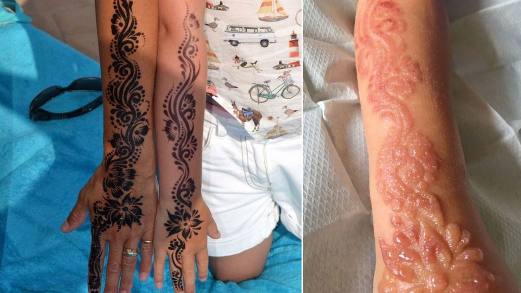 Un tatuaje de henna deja horribles quemaduras a una niña 