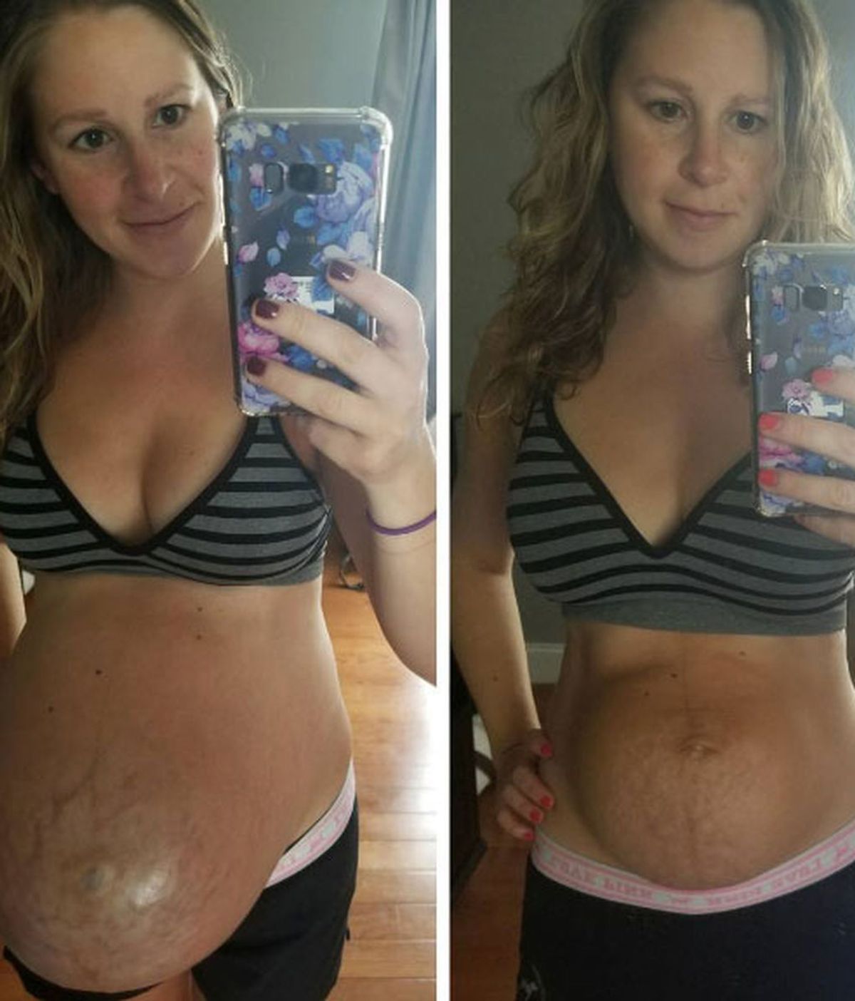 Muestra la realidad del post-parto con fotos de su tripa tres semanas después de dar a luz