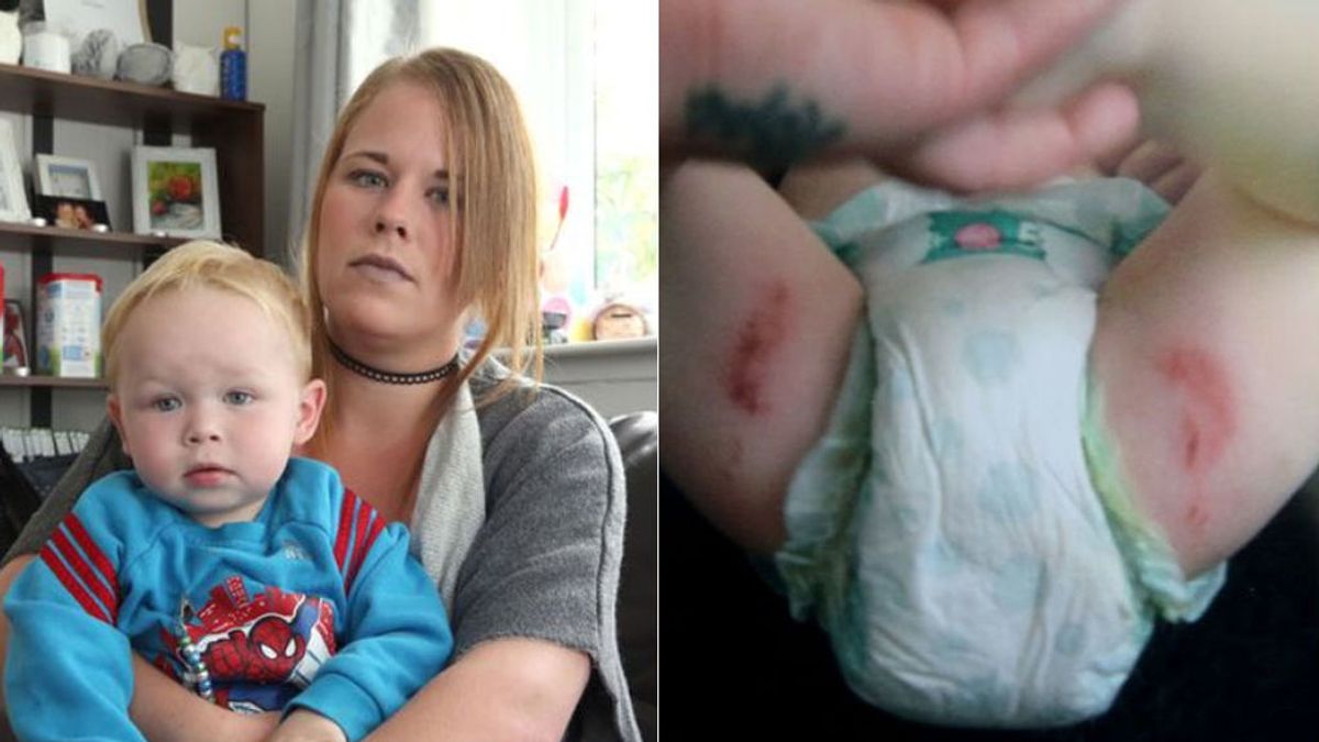 Denuncia que un pañal le provocó "quemaduras químicas" a su bebé