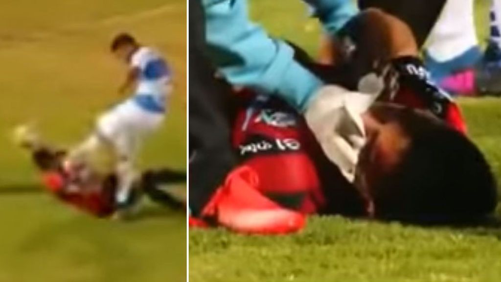 Así le quedó la cara a este defensa chileno tras recibir una patada que le desfiguró el rostro Así le quedó la cara a este defensa chileno tras recibir una patada que le desfiguró el rostro