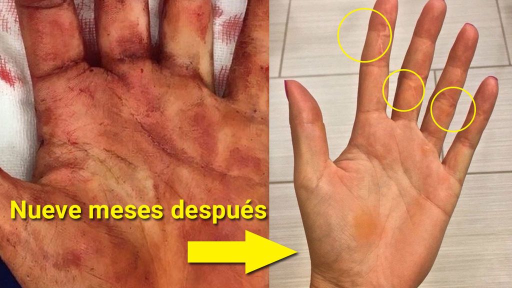¡La increíble recuperación de la mano de Kvitova, destrozada tras un asalto con cuchillo, para vencer a Garbiñe!