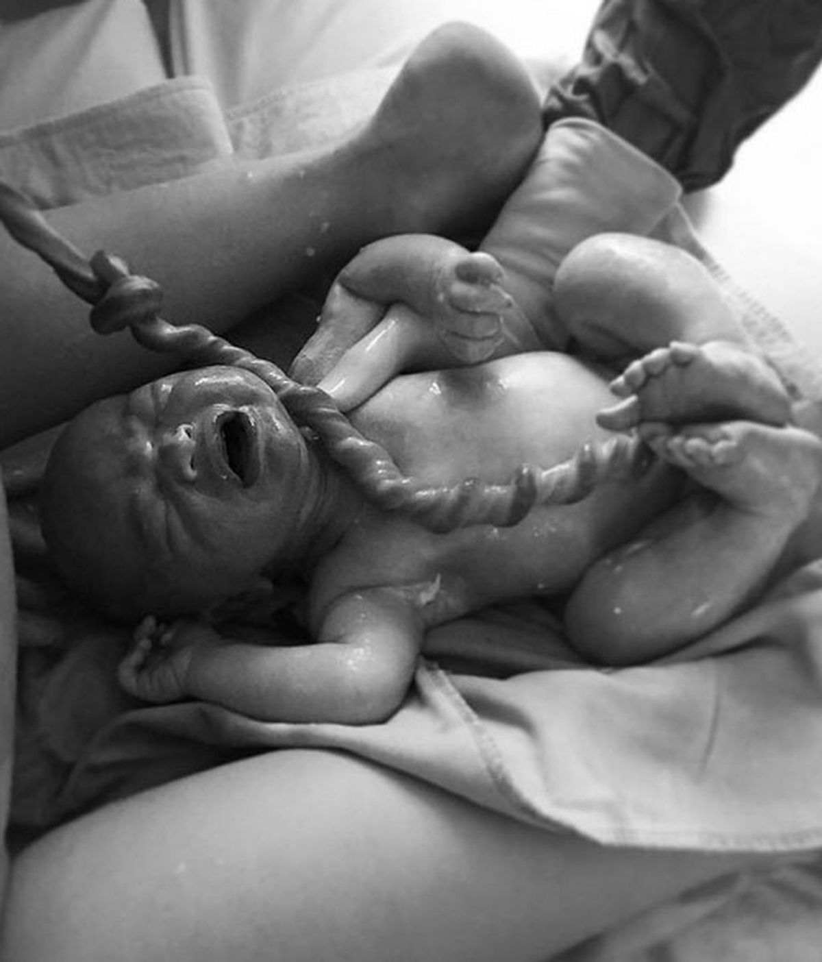 La rareza de nacer con un nudo verdadero en el cordón umbilical