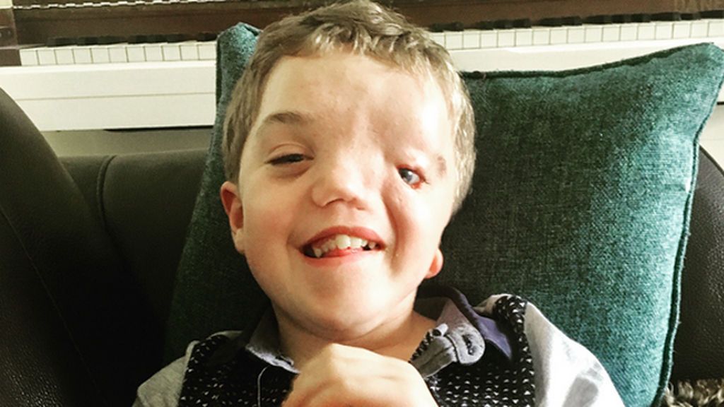 Instagram retira una foto de un niño con deformidad facial