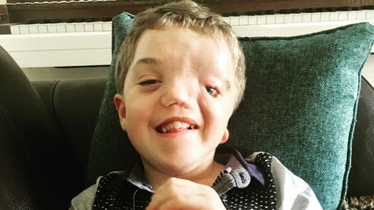 Instagram retira una foto de un niño con deformidad facial