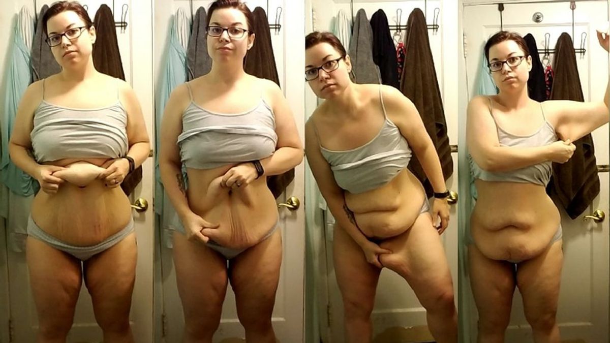 Esta mujer odia aún más su cuerpo tras someterse a una operación para perder peso