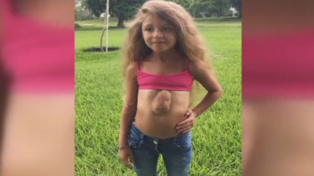 Virsaviya Borun, la niña con el corazón fuera del pecho debido a una rara enfermedad