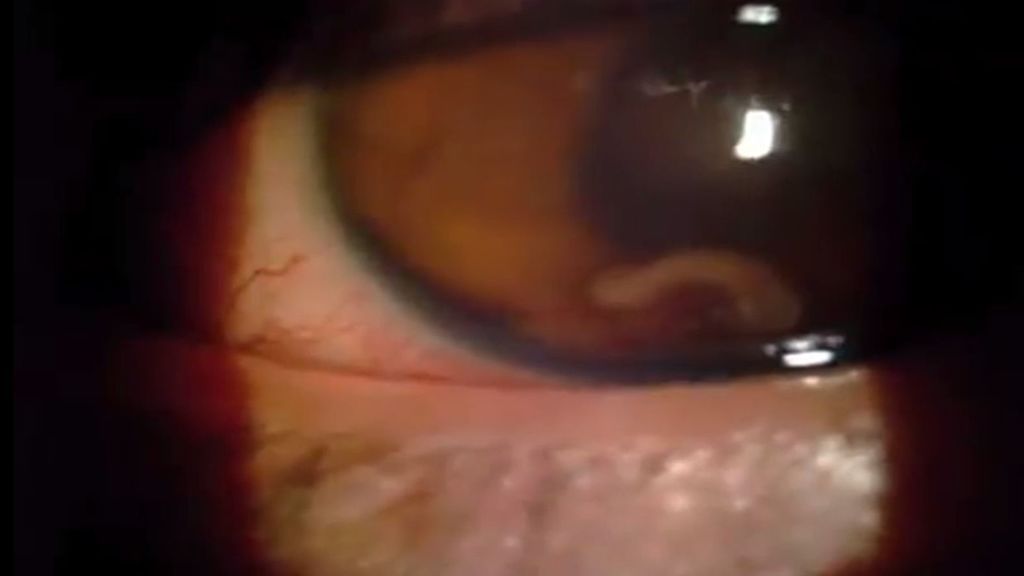 Un gusano le perfora la córnea y el iris y le deja sin visión en el ojo derecho