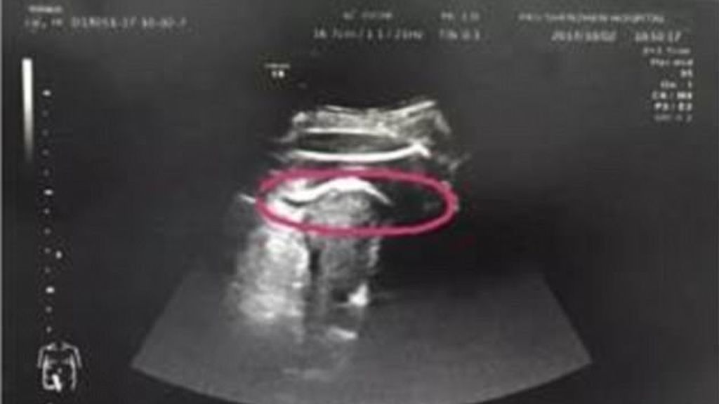 A punto de morir después de que su bebé le perforase el útero de una patada