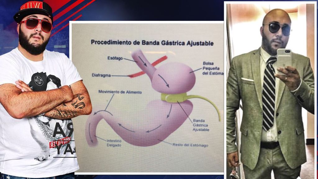 ¡Kiko Rivera podría perder hasta la mitad de su peso! Así es como funciona una banda gástrica