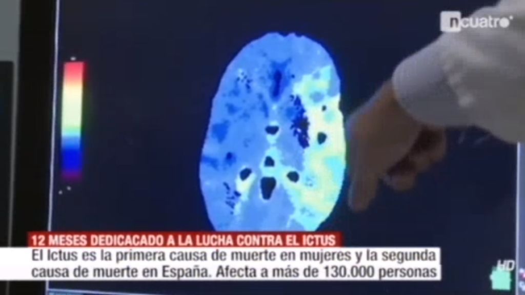 Desde 8 hospitales españoles, nos ayudan a reconocer los síntomas de ictus