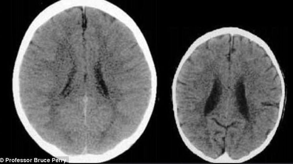 Lo que la falta de amor puede hacer en el cerebro de un niño de tres años