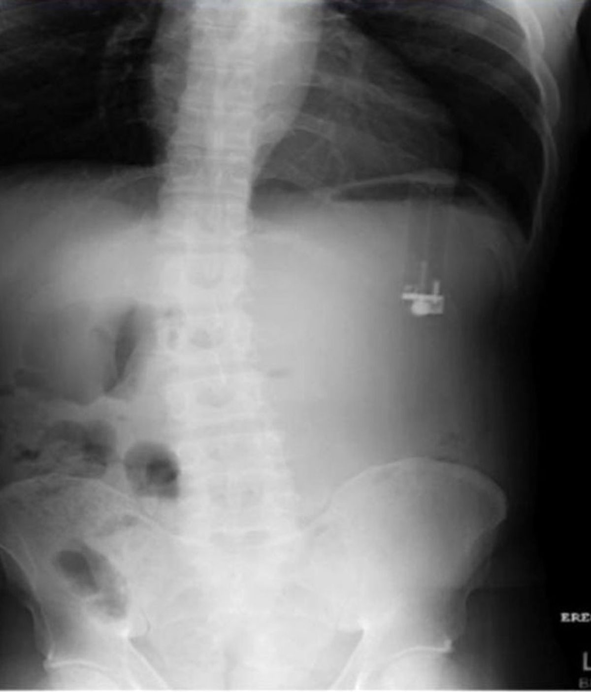 Sufría constantes dolores de estómago: Descubren que se había tragado un encendedor Sufría constantes dolores de estómago: Descubren que se había tragado un encendedor