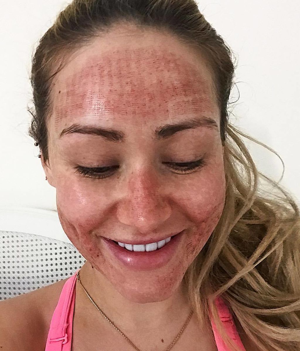Una estrella de la red revela que ha logrado acabar con su acné facial gracias a un tratamiento de láser