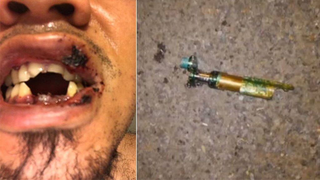 PIERDE CUATRO DIENTES AL EXPLOTARLE UN CIGARRILLO ELECTRÓNICO YAo6coieyyhGMZ81MpsLq