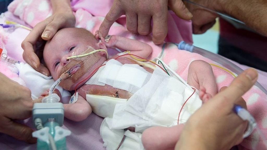 Una niña nace con el corazón fuera del cuerpo y sobrevive tras tres operaciones