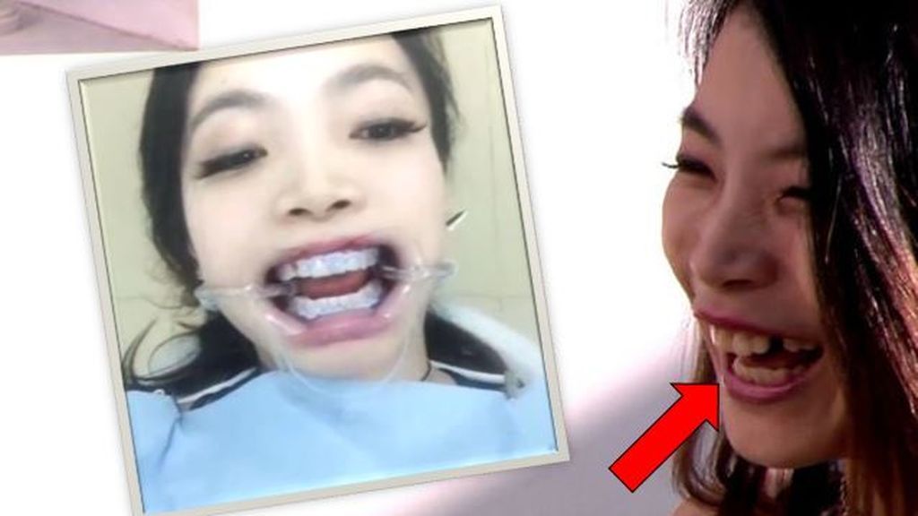 ¡Menuda 'sorplesa'! Yangyang se arregla su diente perdido... ¡y lo retransmite en directo!