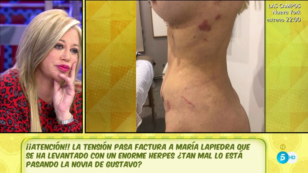 Las fotos del herpes que le ha salido a María Lapiedra por su relación con Gustavo González