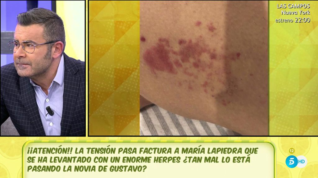 Las fotos del herpes que le ha salido a María Lapiedra por su relación con Gustavo González