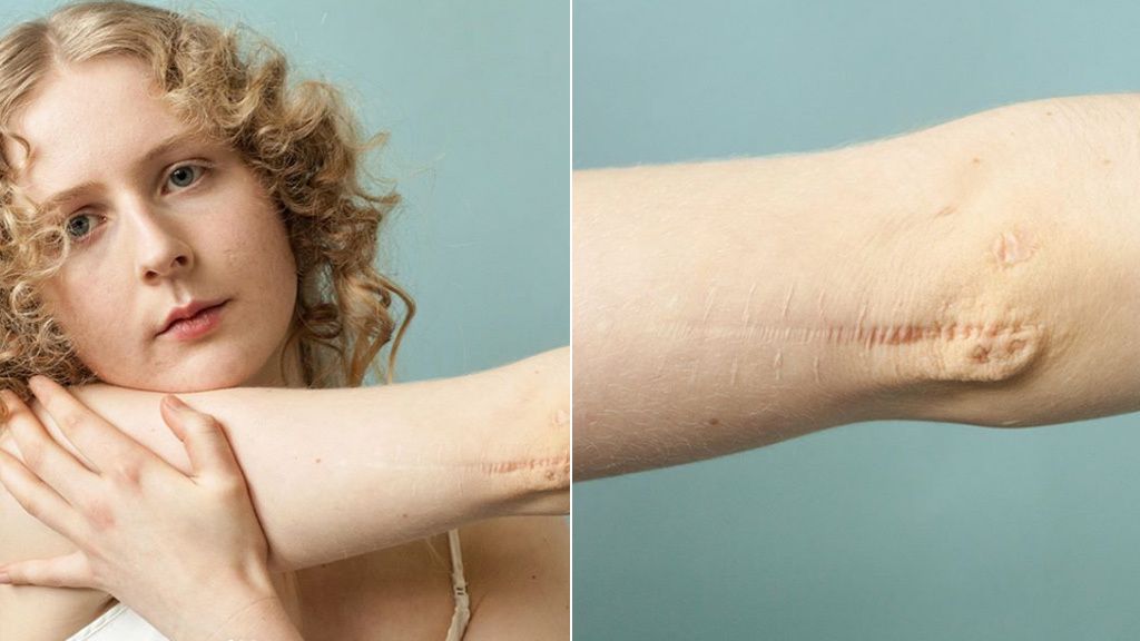 ‘Detrás de las cicatrices’, un proyecto para mimar las marcas de la piel