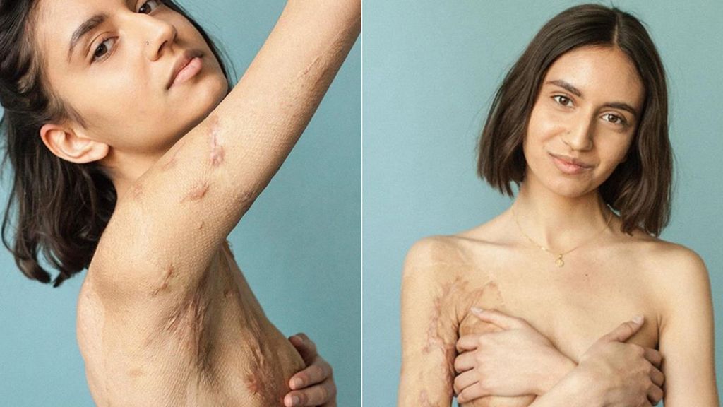 ‘Detrás de las cicatrices’, un proyecto para mimar las marcas de la piel