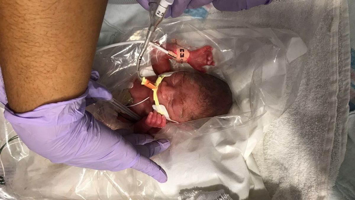 La increíble recuperación de un bebé tan prematuro que tuvo que ser transportado en una bolsa de plástico