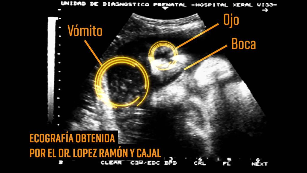 El pensamiento humano antes de nacer: a examen con casos reales intrauterinos de fetos