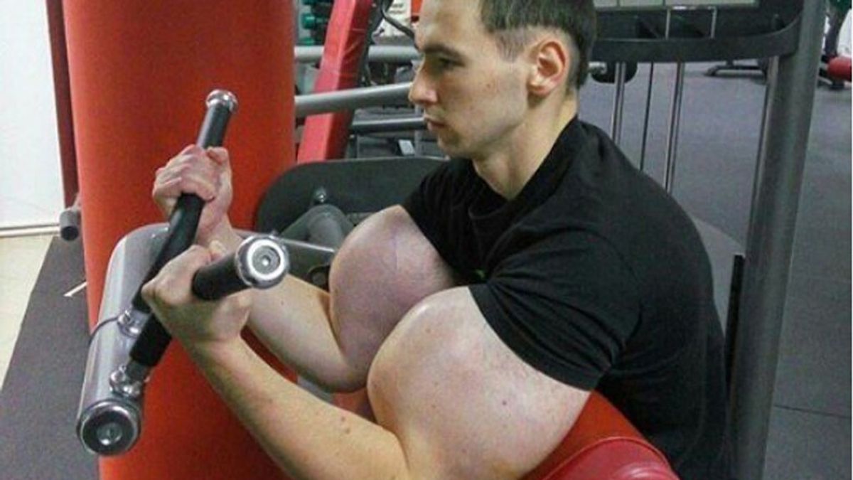 El ‘Hulk' ruso cambia el Synthol por implantes de silicona para seguir aumentando sus músculos