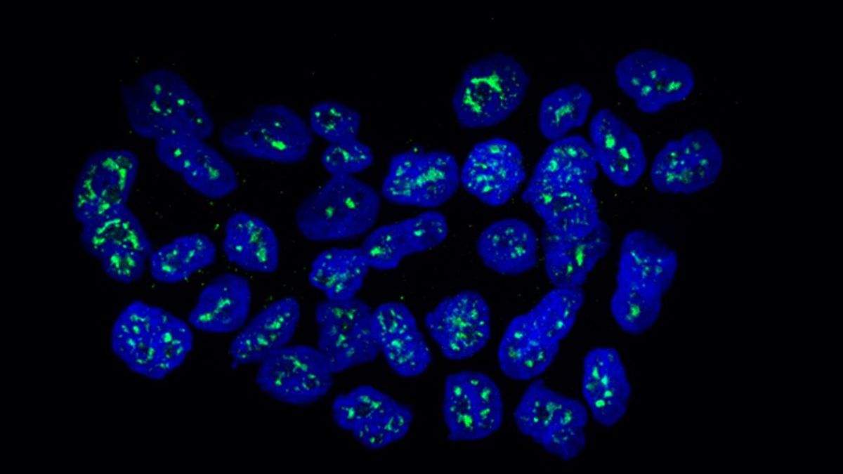 Identifican una proteína que deja dormidas las células en metástasis del cáncer de mama