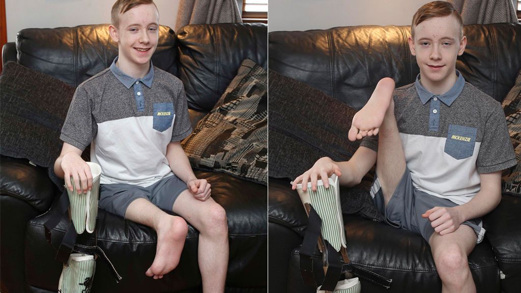 Le unieron el pie a la rodilla para salvar el movimiento de la pierna tras un cáncer… ¡y ahora sueña con ser deportista!