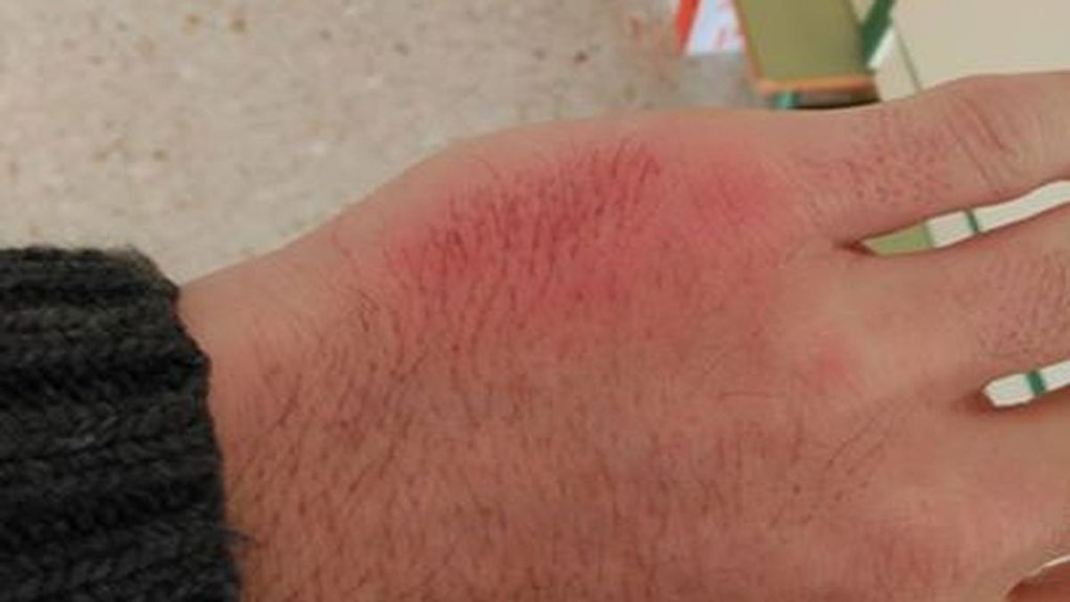 La denuncia viral de un profesor de Jerez: "Esta lesión me la ha causado un alumno"