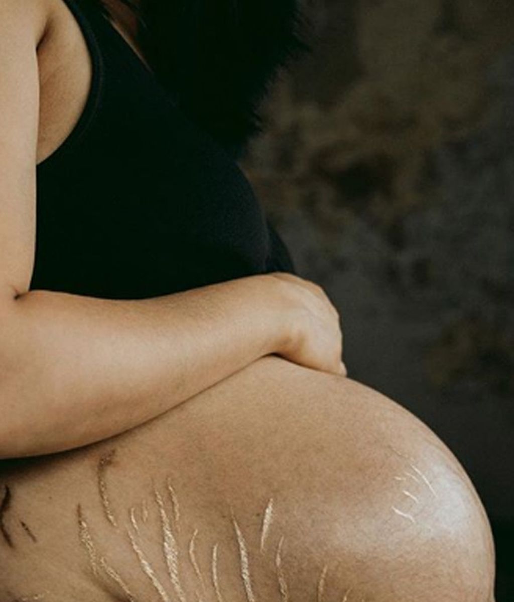 Grace Elizabeth pinta con oro las cicatrices para que dejen de ser un complejo
