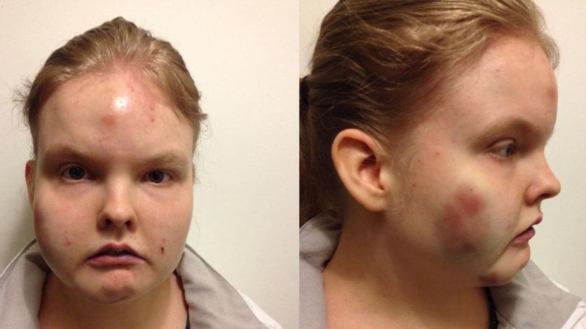 El horror de Lyndsay, con autismo: Lesiones en su rostro y cuerpo tras ser golpeada en el colegio