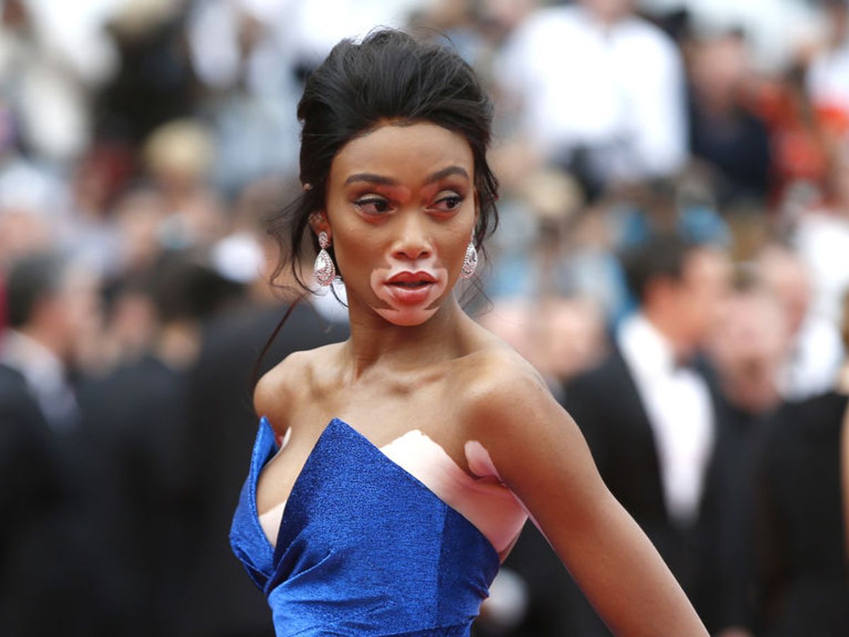 Vivir con vitiligo: la modelo Winnie Harlow muestra sus manchas en ropa  interior