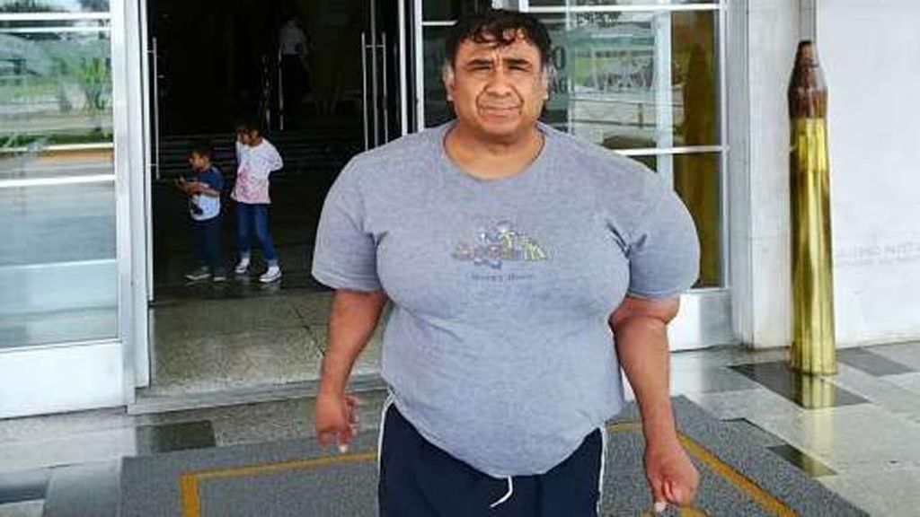 El drama de un buceador peruano: Vive con el cuerpo hinchado tras sufrir un accidente que casi le cuesta la vida