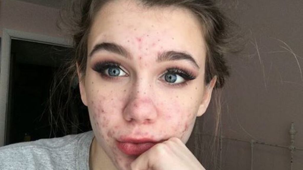 Una adolescente se queda ciega tras tratarse el acné con un antibiótico Una adolescente se queda ciega tras tratarse el acné con un antibiótico