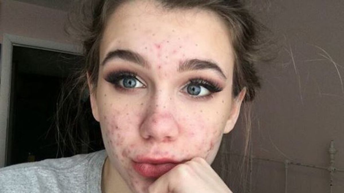 Una adolescente se queda ciega tras tratarse el acné con un antibiótico