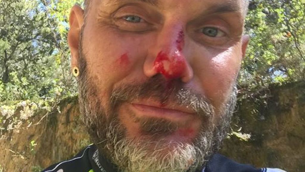 El sangriento accidente deportivo de Nacho Vidal: "Me encanta salir en bici y caerme de boca"