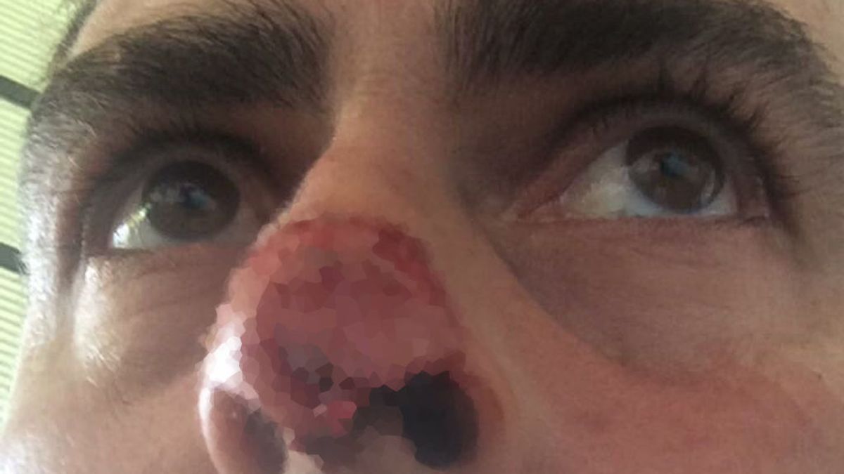 Un futbolista denuncia que un rival le arrancó parte de la nariz de un mordisco en pleno partido de Preferente