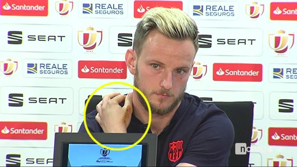La impactante cicatriz en la mano izquierda de Rakitic