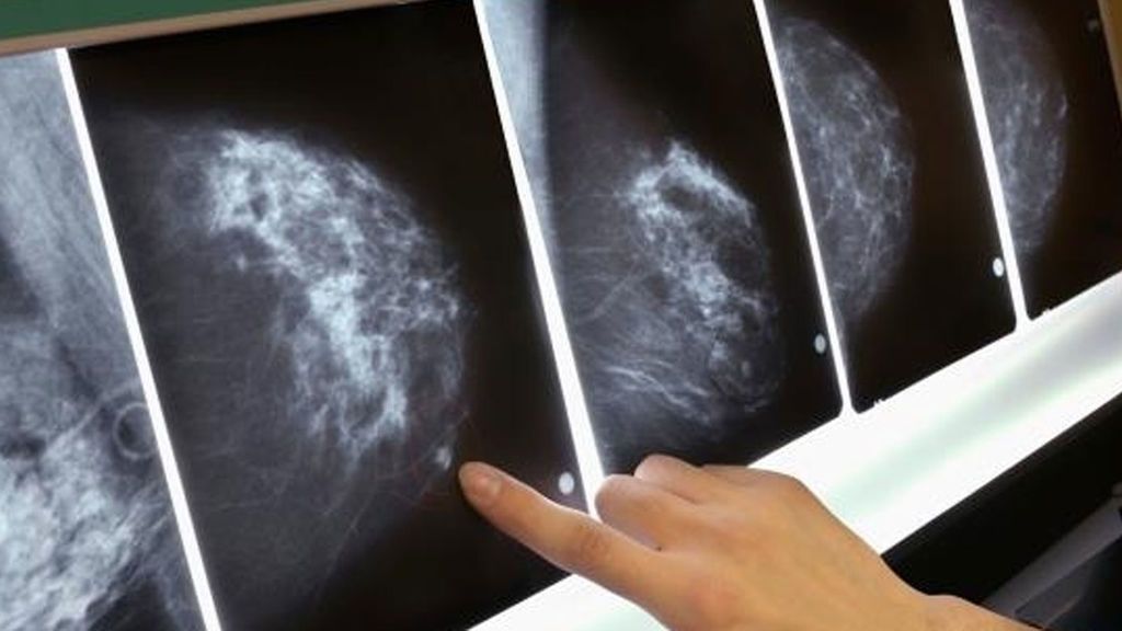 Error informático en la citas para mamografías en Reino Unido pudo provocar más de 200 muertes