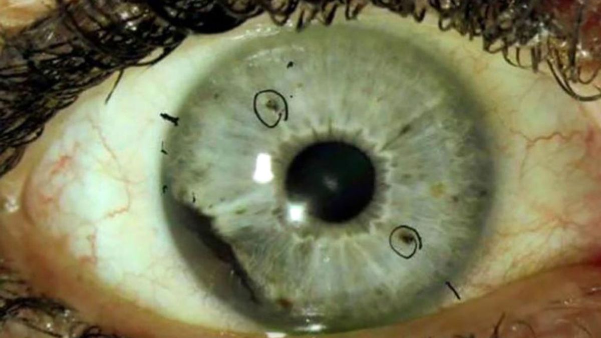 Un raro melanoma  ocular afecta a 48 personas que la mayoría estudió en la misma universidad