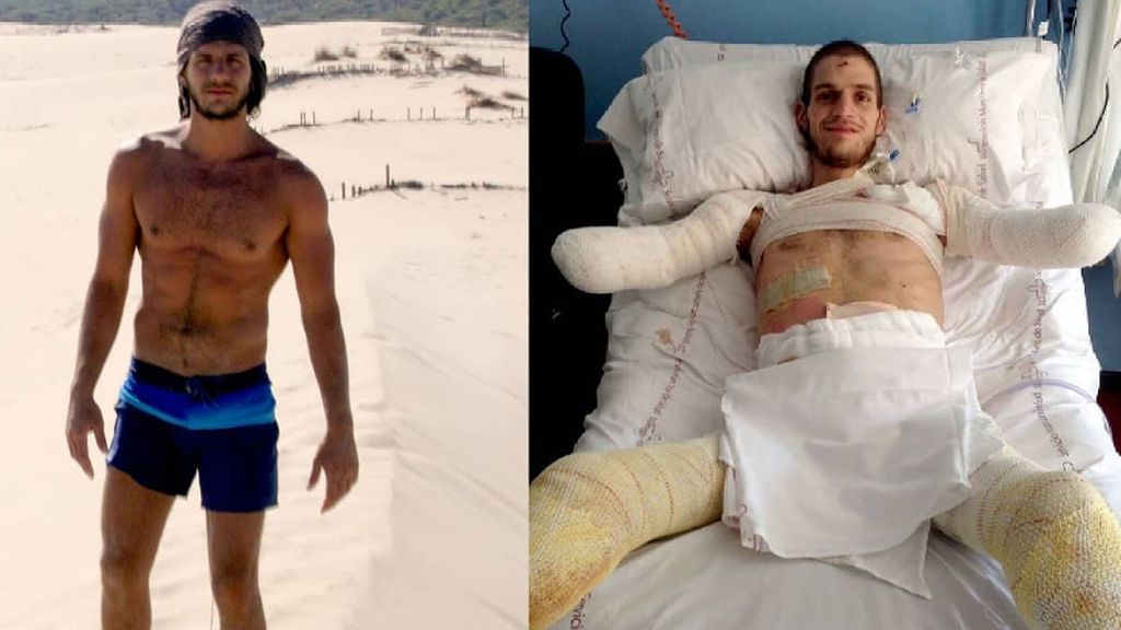 La lucha de Davide, un joven que perdió sus extremidades, para conseguir la prótesis que necesita