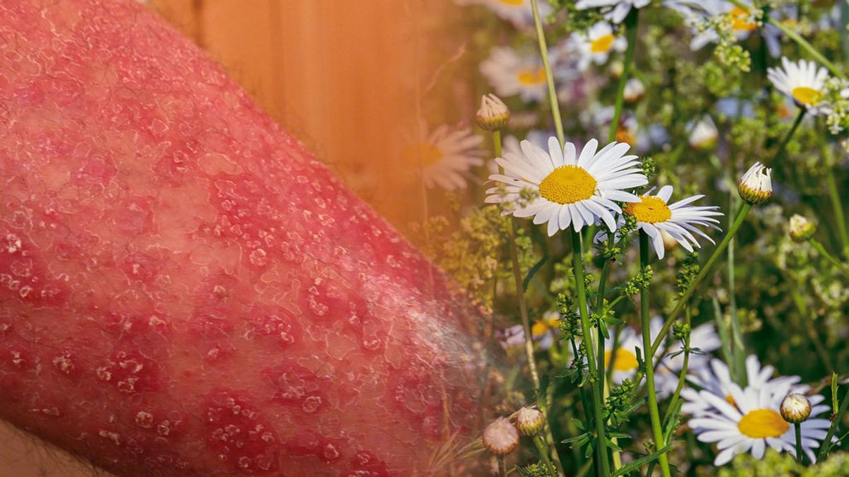 La dermatitis atópica florece más en primavera: qué es y cómo prevenirla