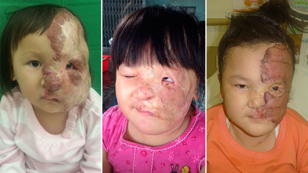 Operan gracias a la solidaridad a una niña vietnamita con un tumor gigante