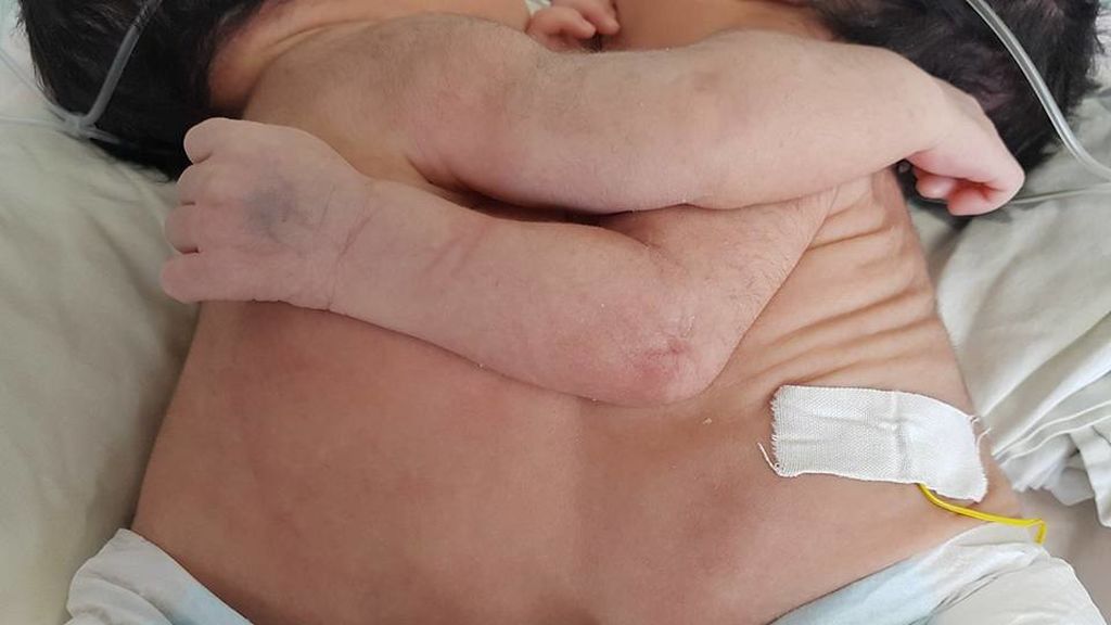 Nacidas dos siamesas que comparten corazón e hígado