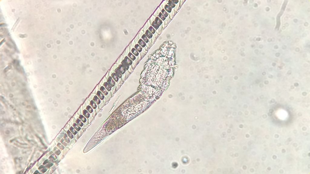 Estos síntomas advierten de que tienes parásitos en el cuerpo