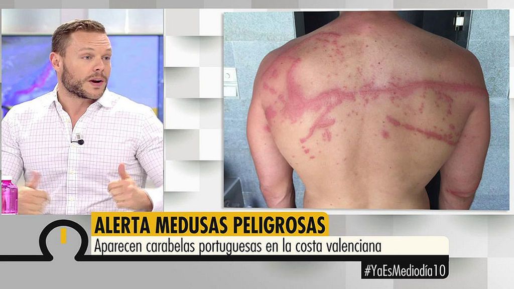 Jano Mecha sufrió la picadura de una carabela portuguesa: "Se me paralizaron los brazos"