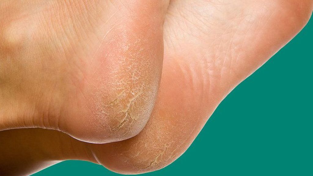 7-reasons-your-feet-are-peeling-1494682214