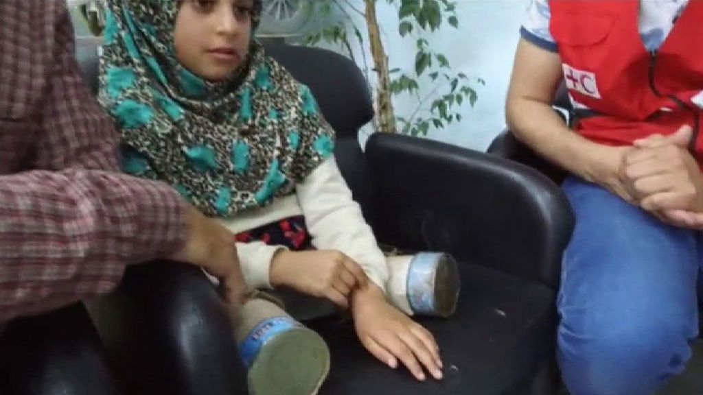 Prótesis para la niña siria que usaba latas para poder caminar Prótesis para la niña siria que usaba latas para poder caminar